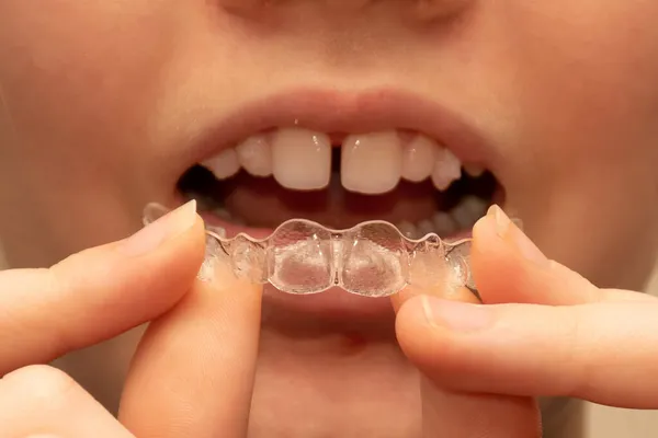 Blisko Dziewczyny Trzymającej Niewidzialny Aparat Zęby Leczenie Ortodontycznych Aparatów Stomatologicznych — Zdjęcie stockowe