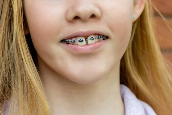 Detailní Záběr Dospívající Dívky Kovových Rovnátkách Ortodontická Zubní Rovnátka Narovnává — Stock fotografie