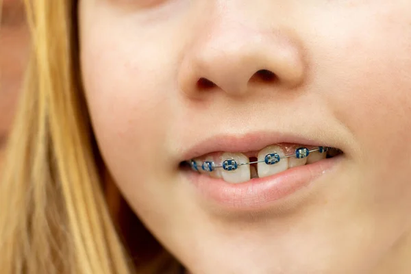 Close up of a teenage girl wearing metal braces. Orthodontic dental braces teeth straighteners. Bracket system. A gap between front teeth