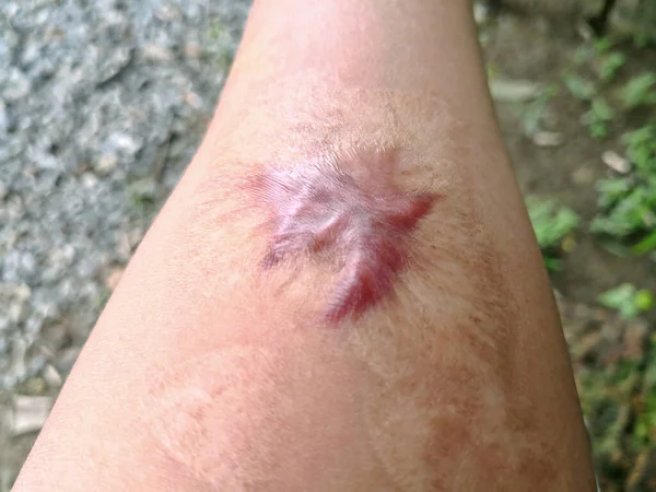 Fechar Cicatriz Queloide Cicatriz Hipertrófica Pele Braço Homem Após Acidente Fotografias De Stock Royalty-Free