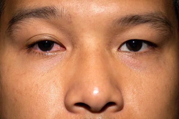 Homem Tem Olhos Vermelhos Causados Por Conjuntivite Doença Inflexão Ocular Imagem De Stock