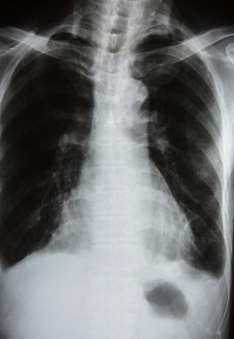 İnsan Göğsünün X-Ray Görüntüsü