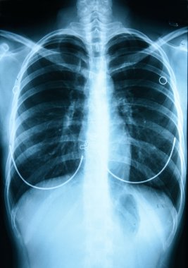 İnsan Göğsünün X-Ray Görüntüsü