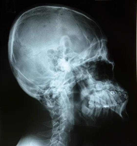 X-ray of head — Stock Photo, Image