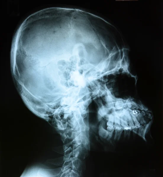 Røntgen av hodet – stockfoto