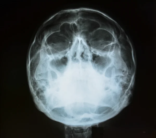 X-ray foto van de schedel — Stockfoto