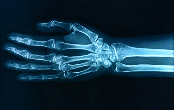 X-ray hand — Stock Photo, Image