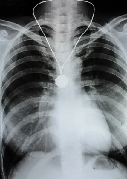X-Ray Afbeelding van de menselijke borst — Stockfoto