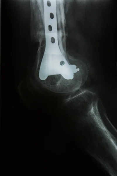 Vänster tibiofibula fixering av fraktur efter operationen, främre röntgen bilderna — Stockfoto