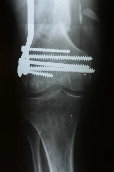 Left tibiofibula fracture fixation after the operation, the front position X-ray pictures — Stock Photo, Image