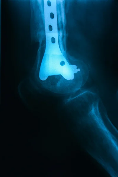 Left tibiofibula fracture fixation after the operation, the front position X-ray pictures — Stock Photo, Image