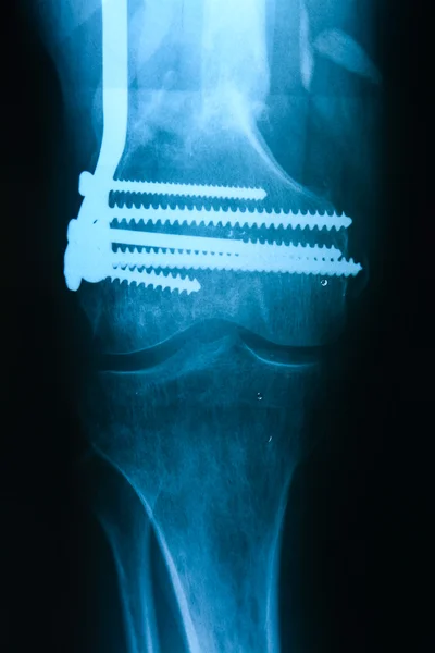 Left tibiofibula fracture fixation after the operation, the front position X-ray pictures — Stock Photo, Image
