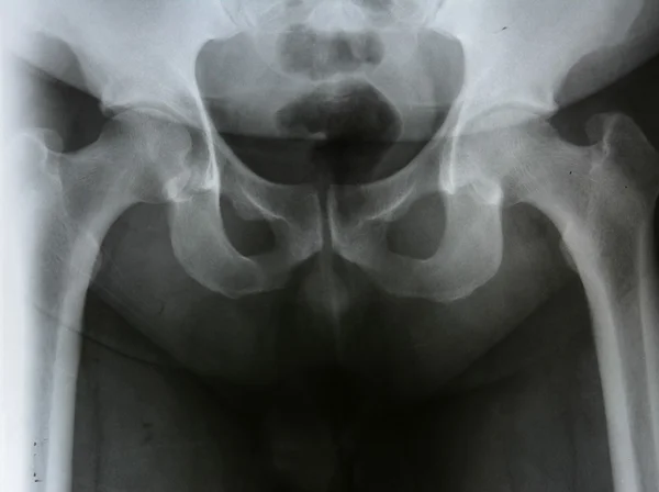 Rontgen picture of male pelvis — Stock Photo, Image