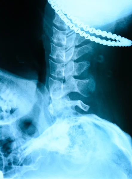Röntgen av halsen — Stockfoto