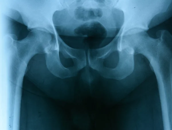 男性の骨盤のレントゲン写真 — ストック写真