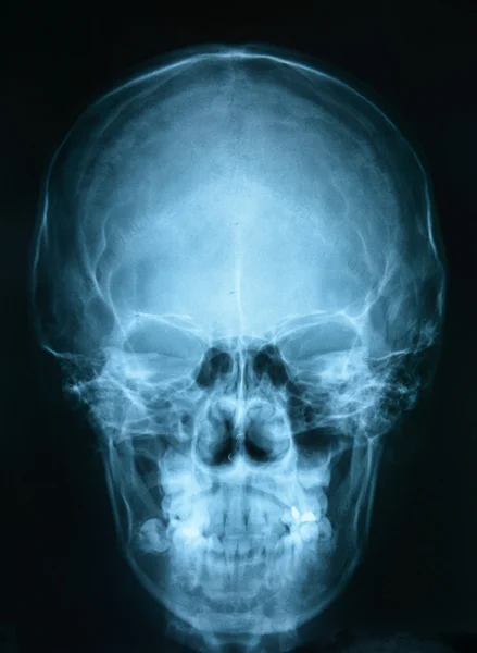 Рентгенівське зображення черепа — стокове фото