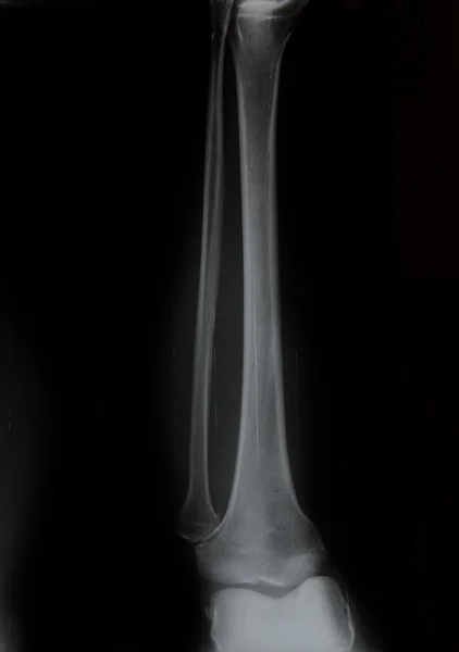 Samling av röntgen-ben och knä — Stockfoto