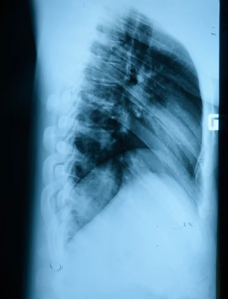 X-Ray Image Of Human Chest — Stock Photo, Image