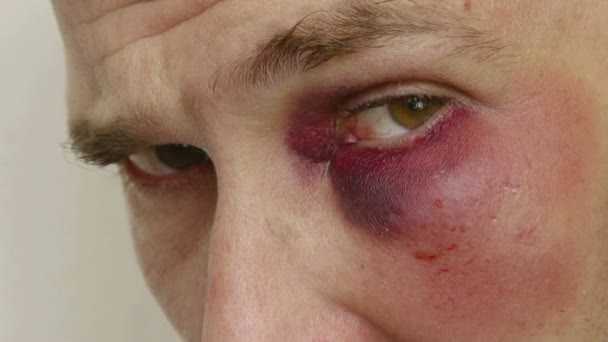 Mannen med ögat blåmärke — Stockvideo