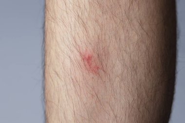 Bacağı kaşındıran sivrisinek ısırığı. Aedes albopictus veya kaplan sivrisineği