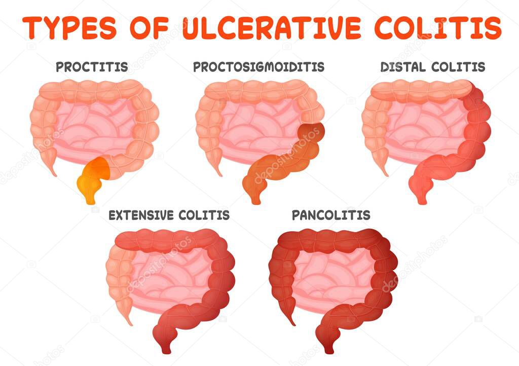 Tipos de colitis ulcerosa, enfermedad intestinal, inflamación