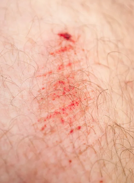 Scratches on the knee — Stock Photo, Image