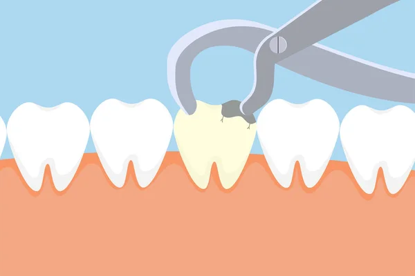 牙医用设备拔出一颗死牙 用牙刷和死牙载体进行的牙科护理活动 死牙拔除说明 取消牙齿的概念 — 图库矢量图片