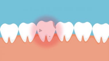 Ölü diş ağrısı ve kırmızı ağrı sinyali veriyor. 4K animasyon. Diş çürükleri ve çene 4K görüntüleriyle enfekte olmuş. Kırmızı tehlike sinyali ve animasyonu olan çürük bir diş..