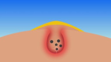 Sivilcelerin içindeki siyah noktaları lazer 4K animasyonuyla öldürmek. Deri aknesi içindeki kiri ve ağrı kesici konsept 4K görüntülerini çıkarıyorum. Sivilceli, sarı iltihaplı, içinde kir olan ve lazerle kiri temizleyen bir kamera..