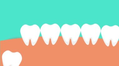 Diş içeriden itiyor ve sakız 4K animasyonuna acı veriyor. Tehlikeli bilgelik diş ağrısı, sakız ağrısına neden olur. Bir yirmilik diş sakızı itiyor ve kırmızı bir ağrı sinyali veriyor..