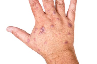 Allergic dermatitis on the skin of the hands to vaccine or medicine. Concept of health, skin care. White background. Right hand.