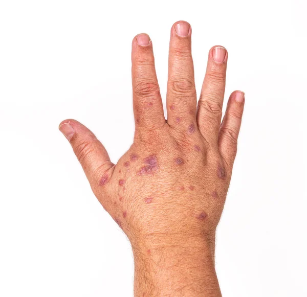 Allergic Dermatitis Skin Hands Vaccine Medicine Concept Health Skin Care — стоковое фото