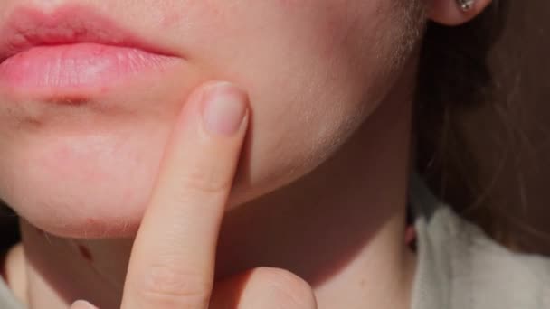 Woman Touching Acne Her Face Skin Health Irritation Wearing Mask — Stock Video