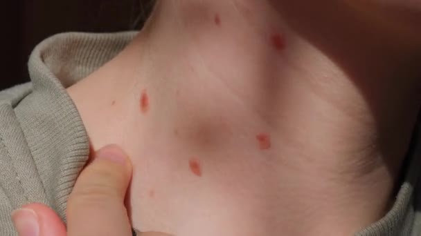 Födelsemärken Huden Närbild Detalj Bar Hud Sun Exponering Effekt Huden — Stockvideo