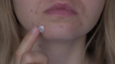 Tanınmayan kadın makyaj yapıyor, yüzüne krem serumu sürüyor. Yüzünde isilik, yara izi ve kozmetiğe alerjisi olan kadınların yakın çekim sivilceleri. Sorunlu cilt bakımı ve sağlık konsepti