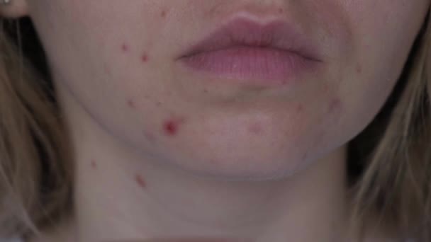 Onherkenbare Vrouw Die Haar Acne Het Gezicht Laat Zien Close — Stockvideo