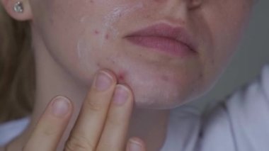 Tanınmayan kadın makyaj yapıyor, yüzüne krem serumu sürüyor. Yüzünde isilik, yara izi ve kozmetiğe alerjisi olan kadınların yakın çekim sivilceleri. Sorunlu cilt bakımı ve sağlık konsepti