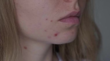 Yüzünde sivilcelerini gösteren tanınmayan bir kadın. Yüzünde isilik, yara izi ve kozmetiğe alerjisi olan kadınların yakın çekim sivilceleri. Sorun cilt bakımı ve sağlık konsepti. Kırışıklıklar, melasma, karanlık.