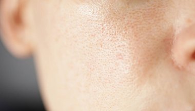 Deri dokusu, büyümüş gözenekler, rosacea ve kızarıklıklarla birlikte sağlıksız. Alerji ve kızarıklık. Hassas cilt konsepti üzerinde çevresel etki. Seçili bulanık odak.