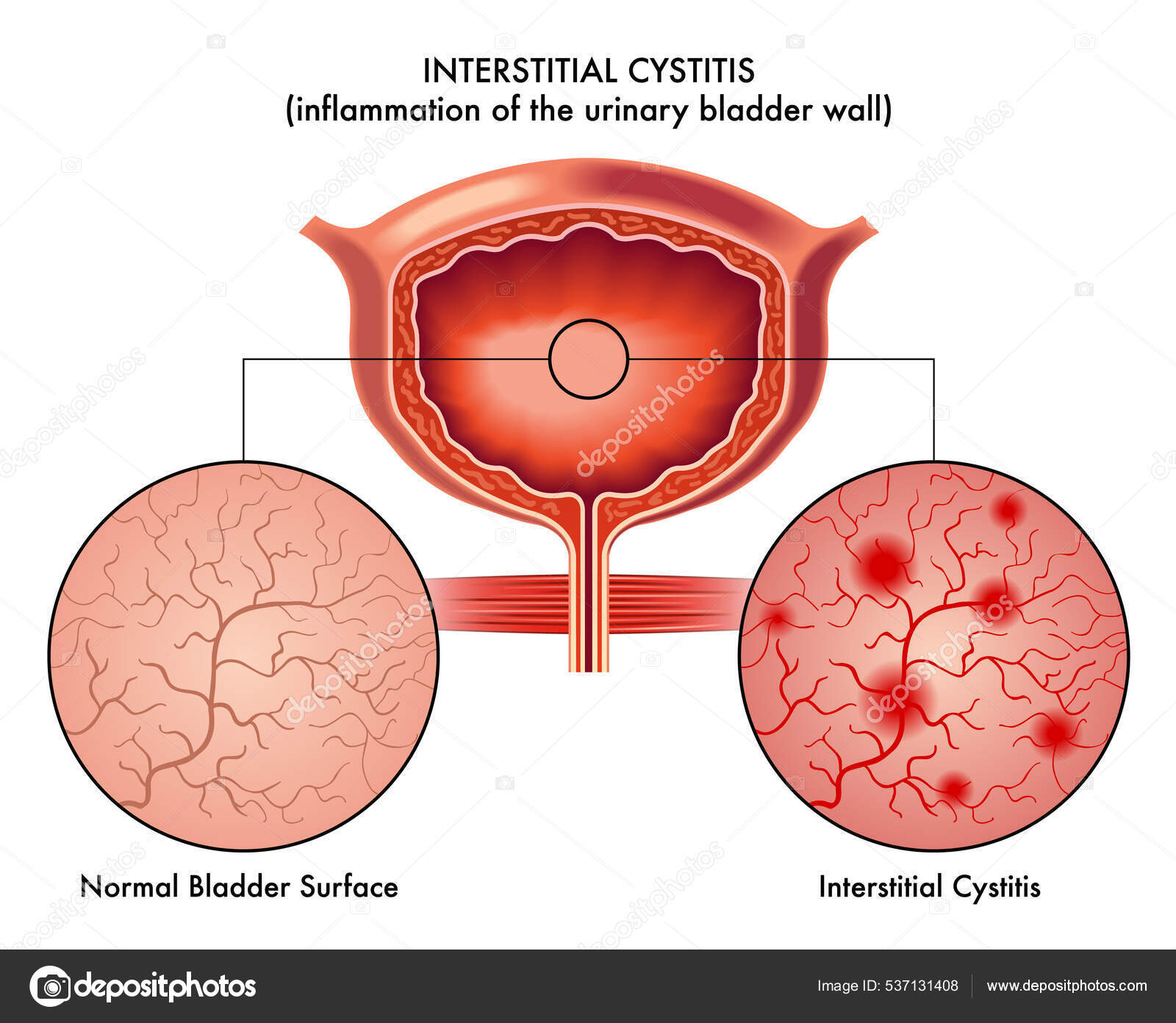 Image vectorielle Illustration Vectorielle Cystite Interstitielle ...