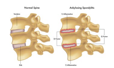Ankilozan spondilit, kemik anatomisi konsepti
