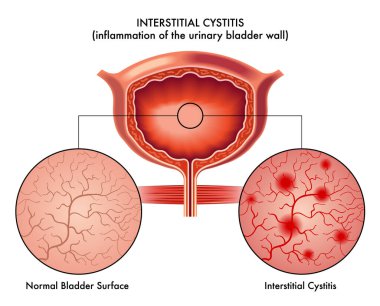 vector illustration of interstitial cystitis, anatomy concept clipart