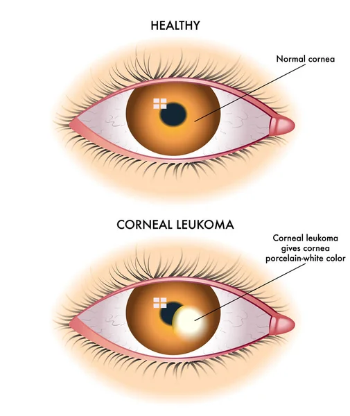 Vector Ilustración Los Ojos Humanos Concepto Enfermedad Leucocitaria Corneal — Vector de stock