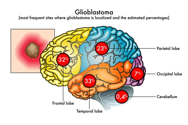 Anatomía Cerebral Humana Vector Ilustración Enfermedad Glioblastoma — Vector de stock