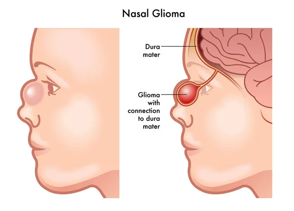 Illustrazione Del Volto Umano Con Malattia Del Glioma Nasale — Vettoriale Stock