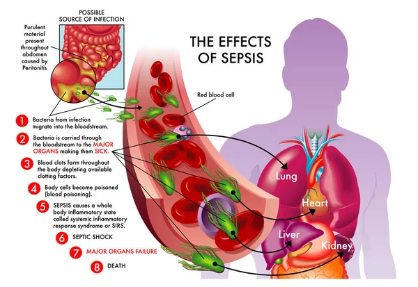 Illustrazione Vettoriale Medica Gli Effetti Del Tema Sepsi — Vettoriale Stock