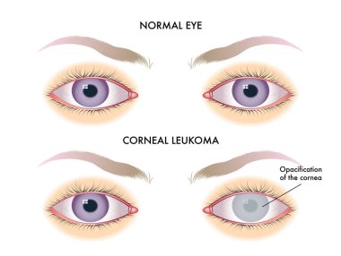 Kornea lökomasının vektör çizimi, anatomi kavramı