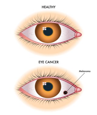 Göz kanserinin vektör çizimi, anatomi konsepti