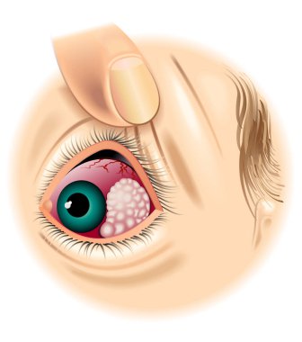 Göz tümörünün vektör çizimi, anatomi kavramı