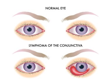 Conjunctiva lenfomasının vektör çizimi, anatomi konsepti